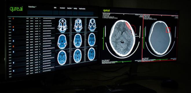 В Индии «научили» искусственный интеллект читать рентгеновские снимки